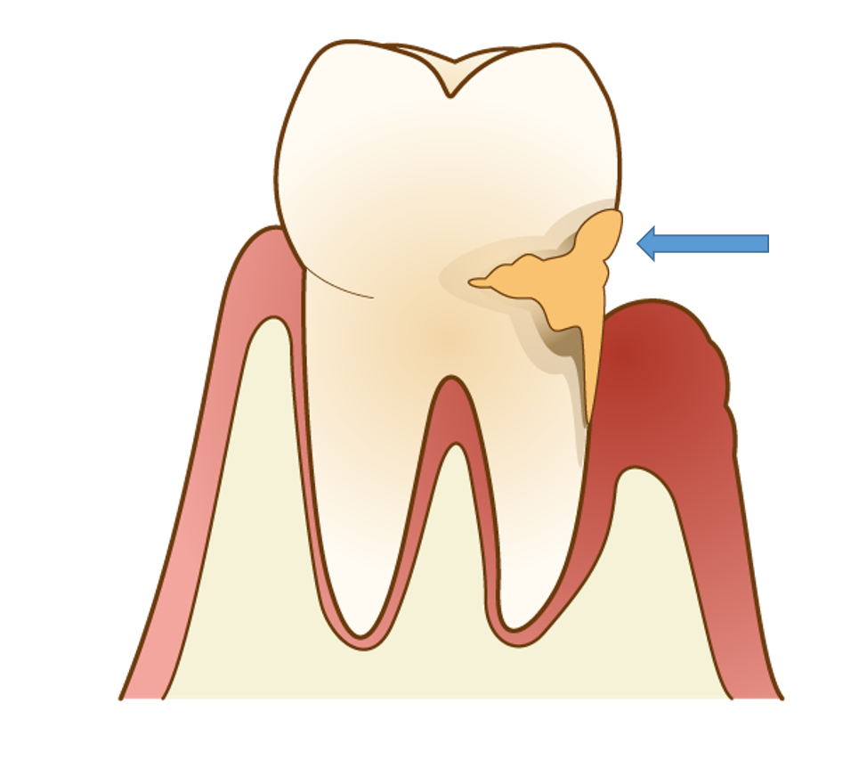 歯石の説明